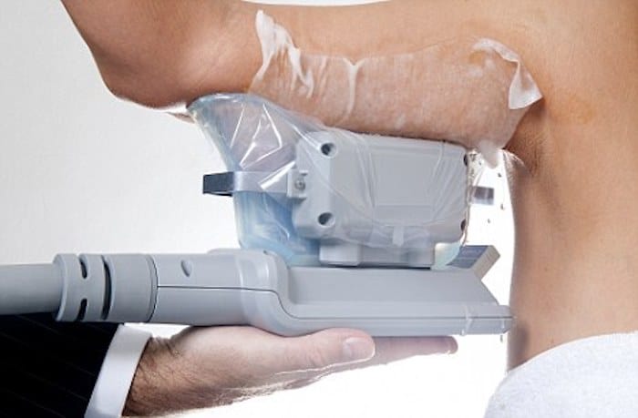 fat freezing arms Hampton Wick