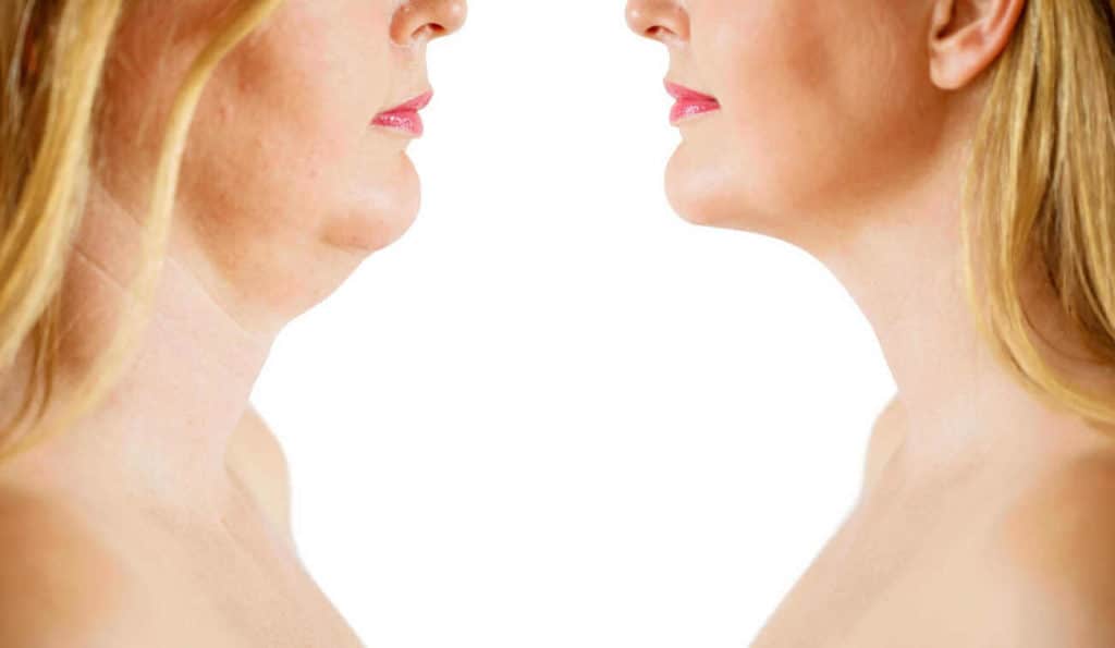 Double Chin treatment Hampton Wick before and after results