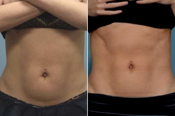 body sculpting FAQs Hampton Wick