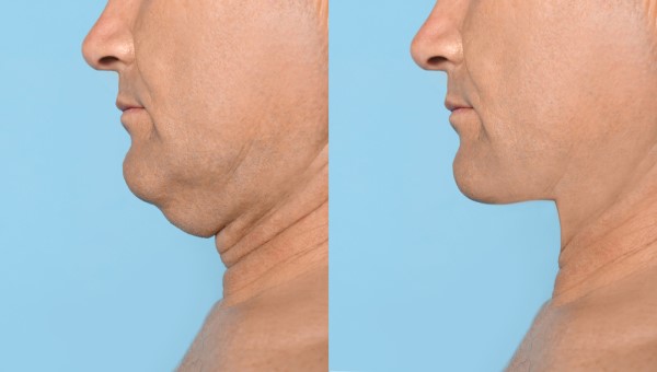 Which Non-Surgical Treatments Work Best for Jowls and Loose Skin Hampton Wick?