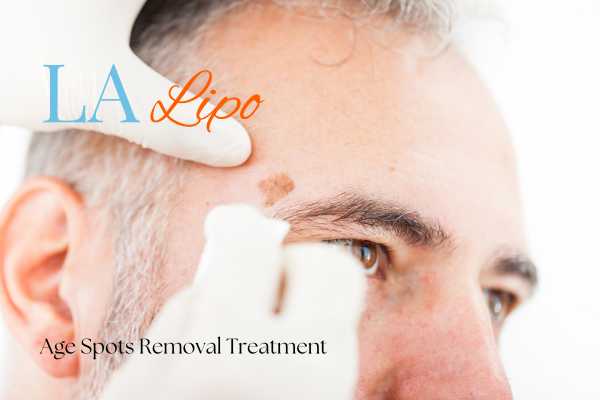 What Are the Most Effective Treatments for Age Spots Hampton Wick?