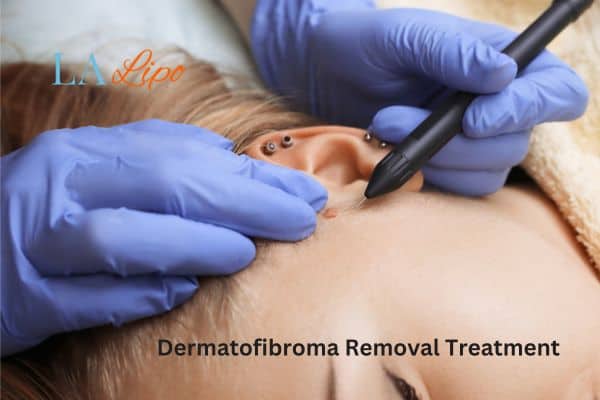 Dermatofibroma Removal Treatment Hampton Wick