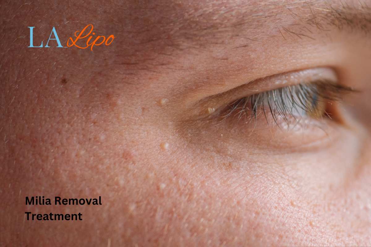 Cryopen Milia Removal: Is It the Easiest and Safest Option Hampton Wick?