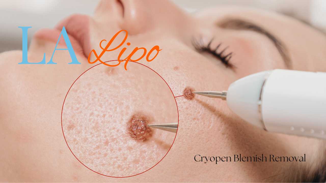 cryopen blemish removal Hampton Wick Contact our team today!