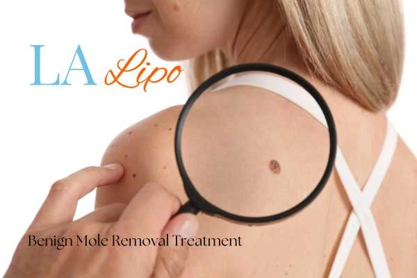 Why getting moles removed Hampton Wick can boost your confidence!