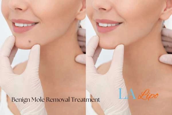 woman's before and after mole removal Hampton Wick results