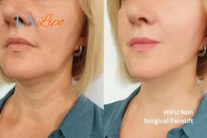 hi-fu for wrinkles Hampton Wick before and after results