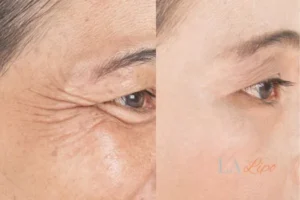 Before and after results of woman - HI-fu wrinkles reduction treatment Hampton Wick