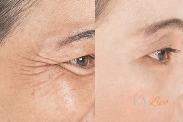 Before and after results of woman - HI-fu wrinkles reduction treatment Hampton Wick