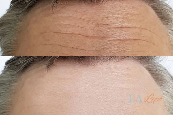 results of HIFU Hampton Wick on mans forehead to help reduce lines and wrinkles