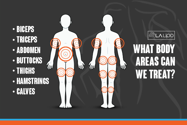 Graphic to show areas you can have LA-EMS Body Sculpting Hampton Wick treatment.