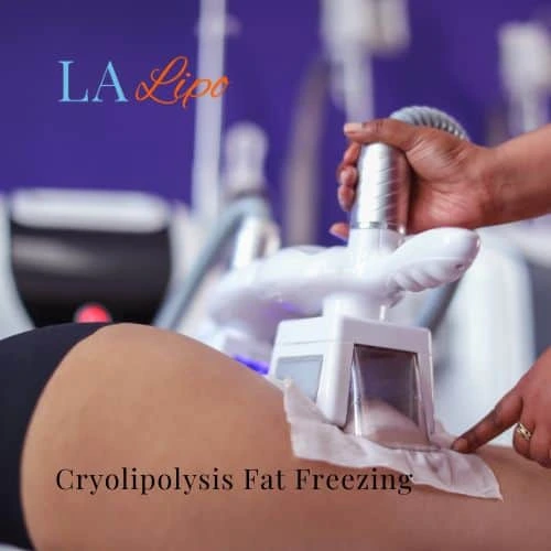 fat freezing - Cryolipolysis Hampton Wick