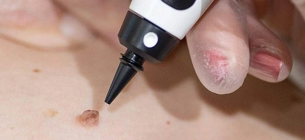 skin tag removal using cryopen Hampton Wick