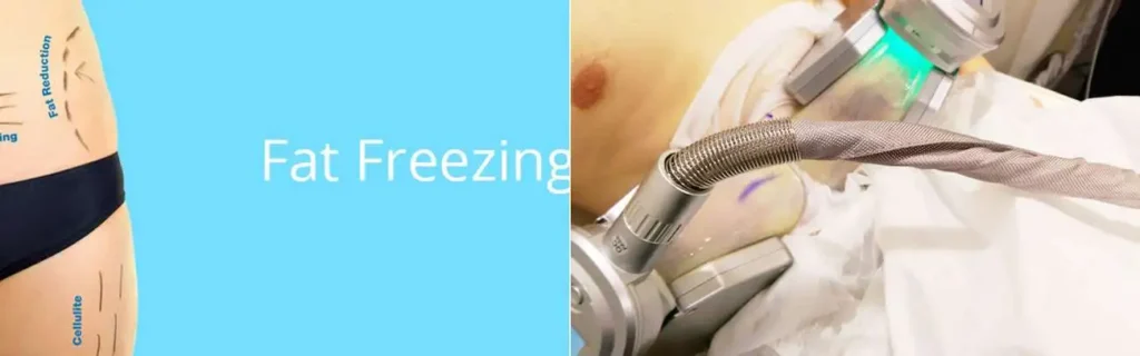 Fat freezing Hampton Wick on multiple areas of the body
