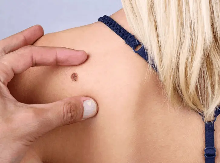 woman having mole removal Hampton Wick consultation before treatment.