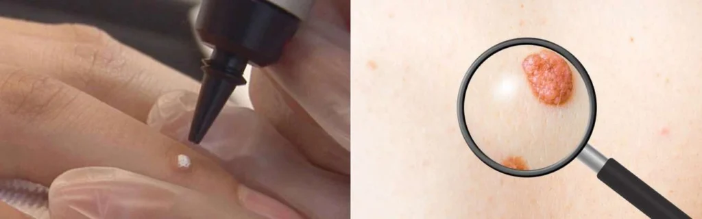 Person getting moles removed with cryopen Hampton Wick