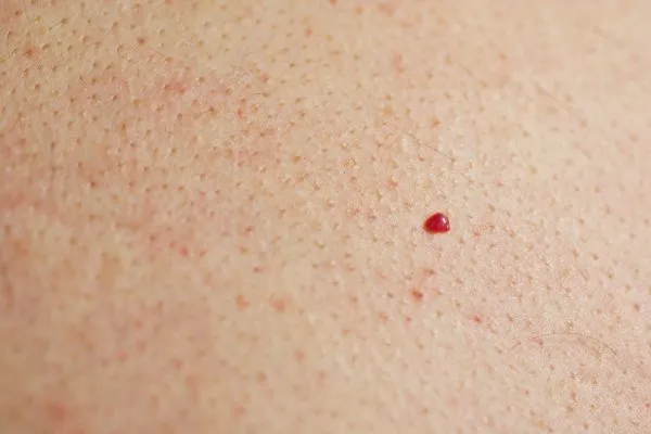 close up of a cherry angioma Hampton Wick