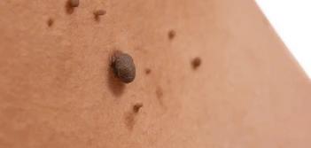 image of a skin tag Hampton Wick