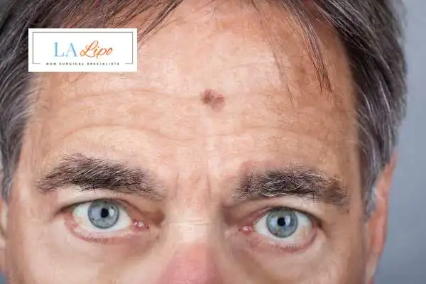 Solar Lentigo Removal Hampton Wick image of man with mark on his forehead