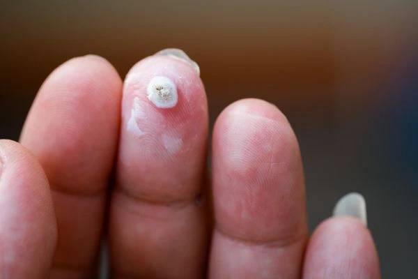 wart on person finger - cryotherapy to treat from LA LIPO Hampton Wick