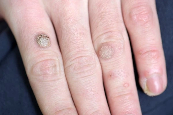 photo of warts on person hand - see wart removal Hampton Wick from LA LIPO