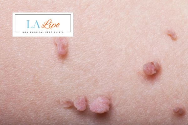 Does cryopen skin tag removal Hampton Wick hurt? Find out now call our team today!