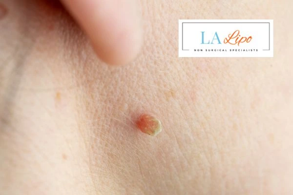 Book skin tag removal Hampton Wick today speak to our team now!