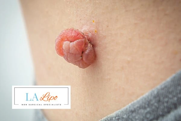 Interested in skin tag removal Hampton Wick? Concerned about the pain? Find out more today!