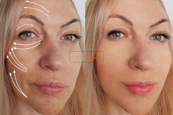 Morpheus 8 results Hampton Wick face lift.