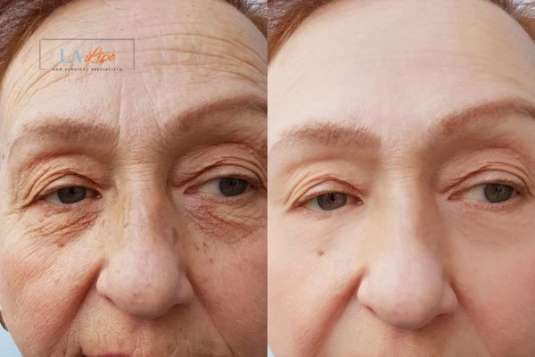 The powerful benefits of Morpheus8 Treatment Hampton Wick - Call Our team today!