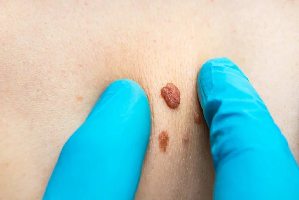 LA LIPO Cryopen Lesion Removal Prices Hampton Wick