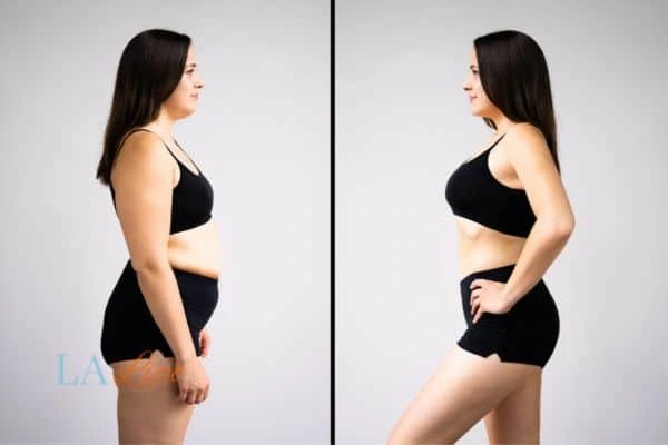 Picture of womans before and after using LA-EMS body sculpting to improve her core strength Hampton Wick