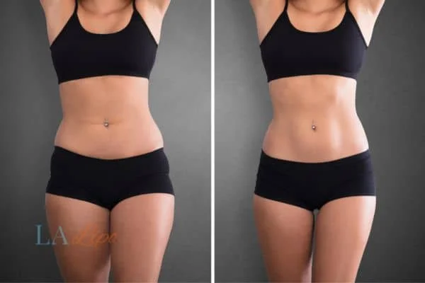 before and after results of non-surgical treatment to help a woman's body image and mental health Hampton Wick