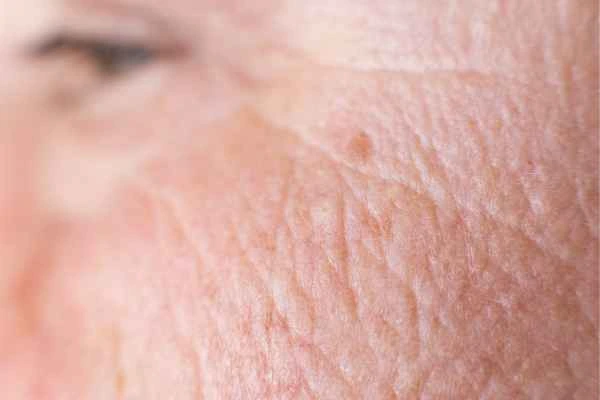 close up picture of a woman's face showing an age spot Hampton Wick