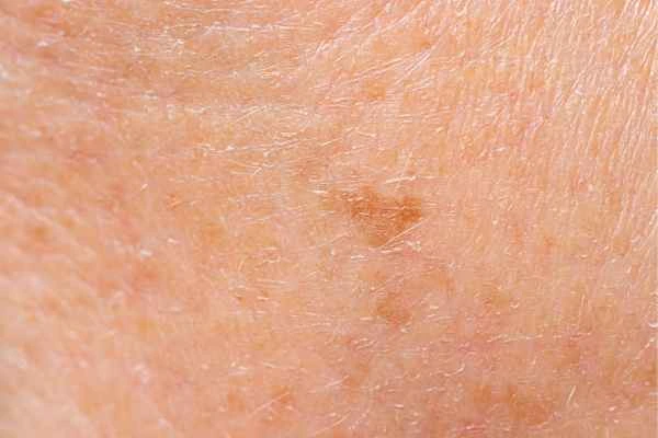 close up picture of age spots Hampton Wick