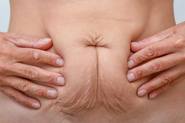 Image of a woman's stomach with loose skin - example of skin tightening Hampton Wick options