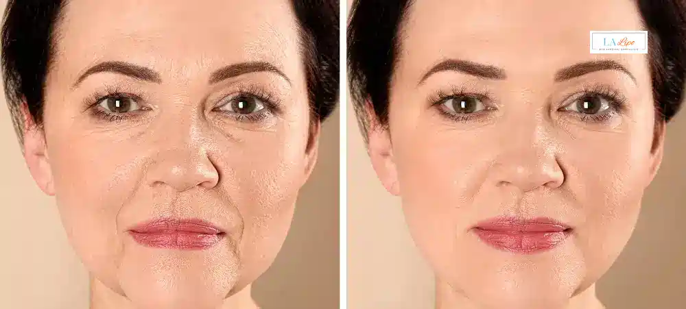 How Long Does It Take to See Results and How Long Do They Last Hampton Wick?