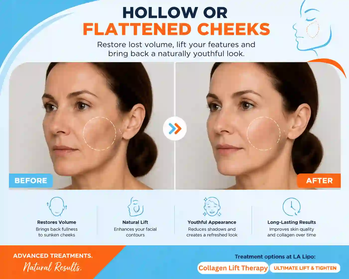 Sign #4: Hollow or Flattened Cheeks Hampton Wick