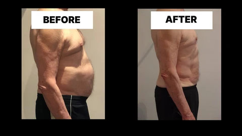 What Symptoms Can Diastasis Recti Cause in Men? Weak Core, Back Pain and Poor Posture Hampton Wick
